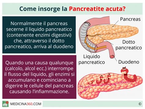Scopri la diagnosi e la dieta da seguire. Pancreatite acuta: cause, sintomi, diagnosi, cura ed ...