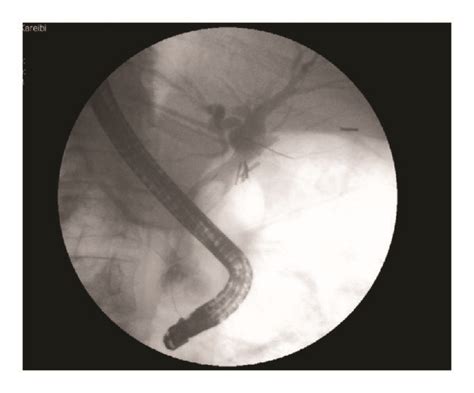 Ercp Showing A Large Filling Defect In A Dilated Common Bile Duct With