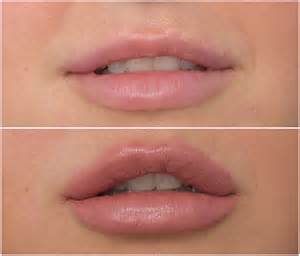 Bizarre Case Of Lip Fillers Gone Horribly Wrong Questioning Safety