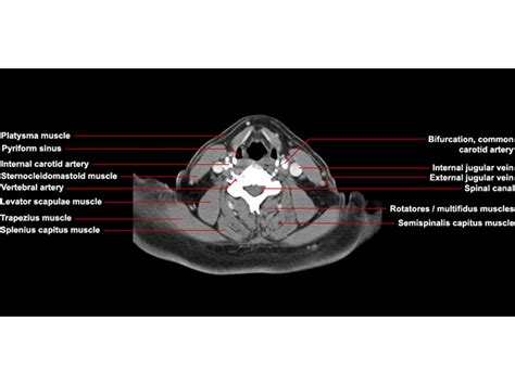 Axial Ct Neck Anatomy