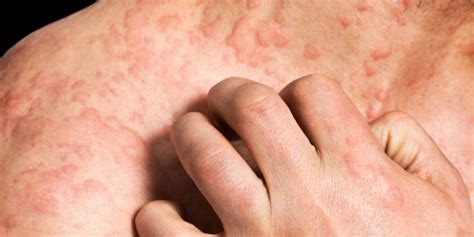 Research Finds Contagious Staph In Lupus Related Skin Rashes Consumer