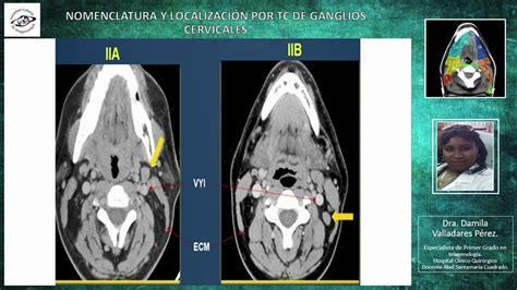 Localización Y Nomenclatura De Las Cadenas Ganglionares Cervicales