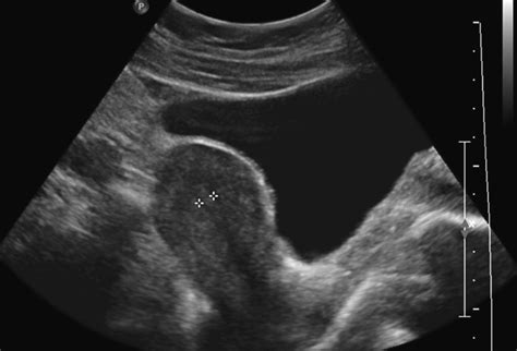 Normal Uterus Measurements Ultrasound
