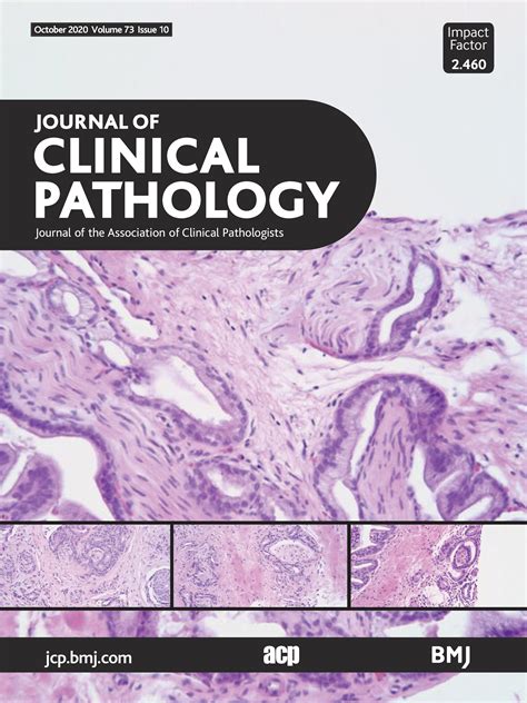 Hpv Related Squamous Cell Carcinoma Of Oropharynx A Review Journal