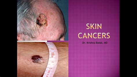 Skin Cancers Part Ii Youtube