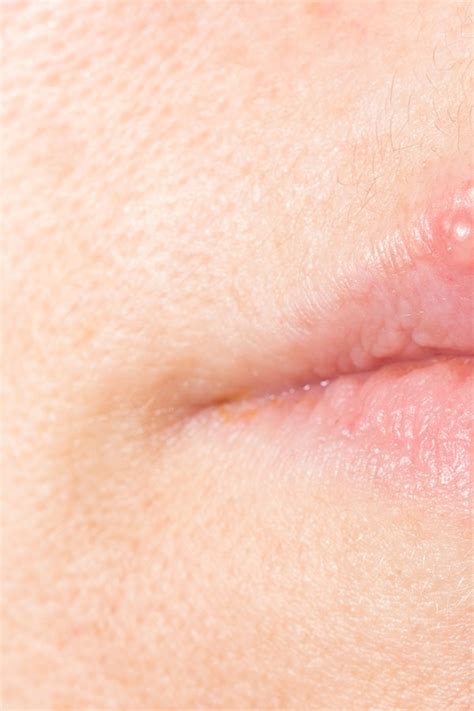 Herpes An Den Lippen Richtig Behandeln Ndrde Ratgeber Gesundheit