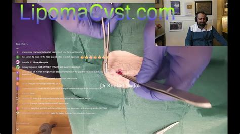 Massive Cyst Removal Dr Khaled Sadek Live Chat 26th Feb 2023 Youtube
