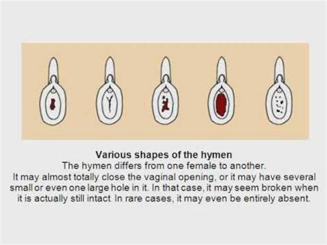 Diagram Of An Hymen