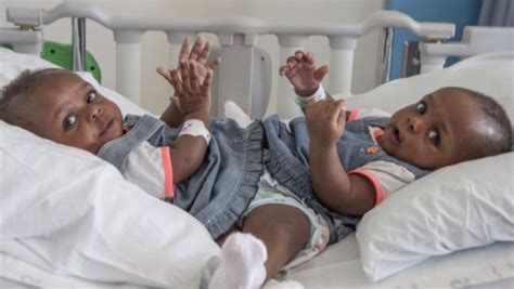 Conjoined Twins Separated With Surgery