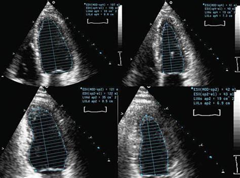 Echocardiographic Evaluation Of Systolic Heart Failure Lo 2009 Australasian Journal Of