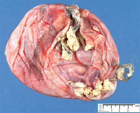 Ovarian Cyst With Hair And Teeth Spefashion