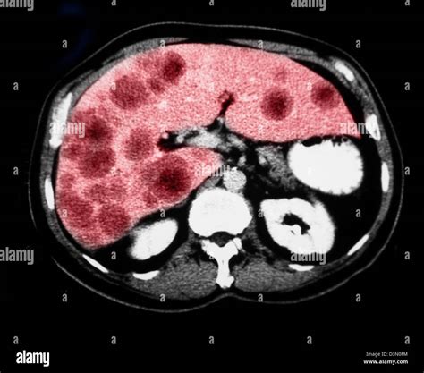 Des Coupes Scanner Montrant Un Cancer Du Foie Métastatique Photo Stock