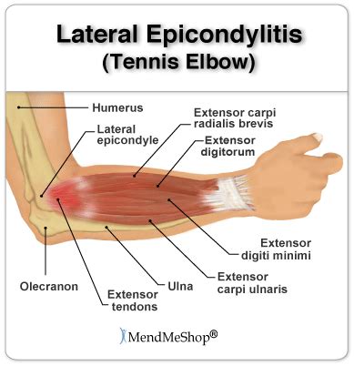 A tendon is the fibrous tissue that attaches muscle to bone in the human body. Elbow/Forearm Tendon Ligament Tear | Health Life Media