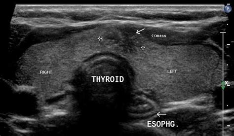 Enlarged Thyroid Thyroid Nodules Pinterest