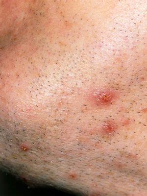 A pubic hair may, sometimes, get coiled as it grows, to enter back into the skin. What Is That Skin Growth? - Skin and Beauty Center ...