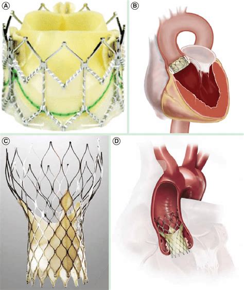 Photographs Of The Transcatheter Prosthetic Valves Currently Used For