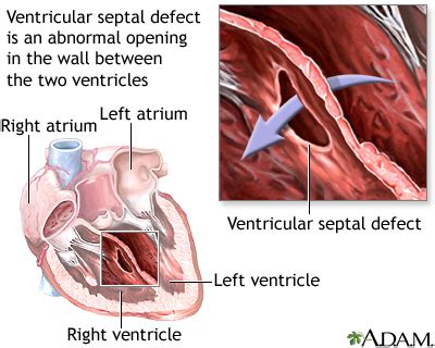 Ventricular Septal Defect MedlinePlus Medical Encyclopedia Image