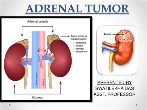 Adrenal Gland Cyst Symptoms