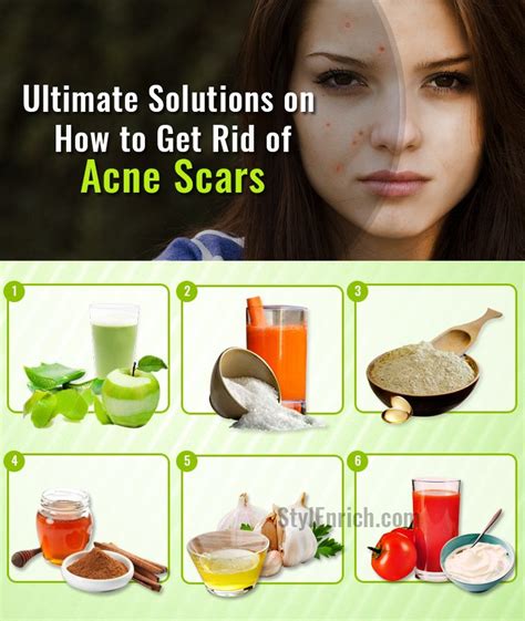 How To Get Rid Of Acne Scars With Top 10 Ultimate Solutions
