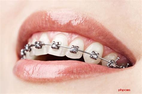 Les Appareils Fixes Et Amovibles French Dentist China
