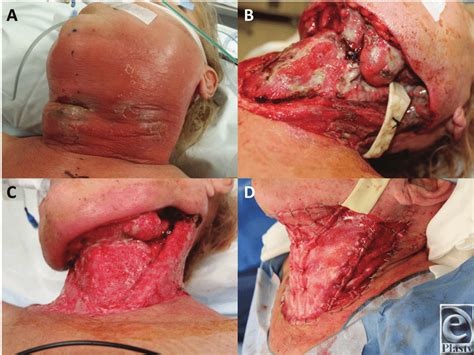 A Initial Presentation Gross Swelling Of The Left Face And Neck