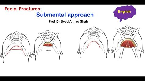 Submental Approach Oral And Maxillofacial Surgery English Syed Amjad Shah Youtube