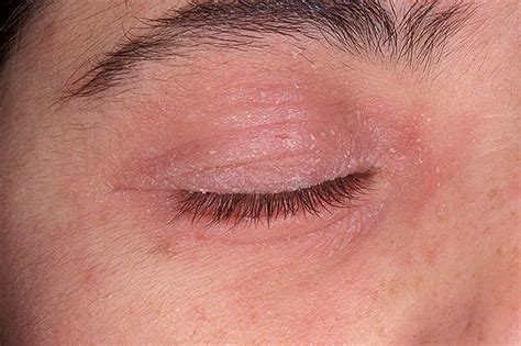 Oftalmološka Poliklinika Dr Balog Eyelid Dermatitis