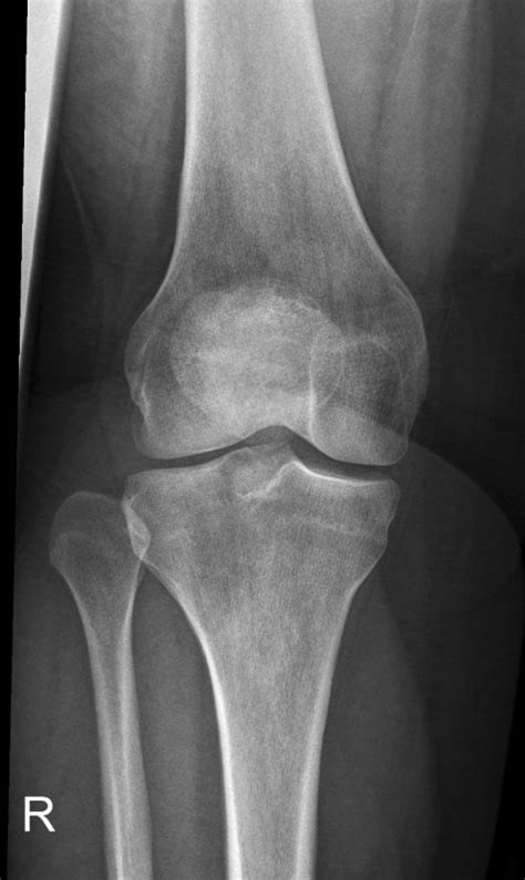 Proximal Tibiofibular Joint Dislocation Wikiradiography