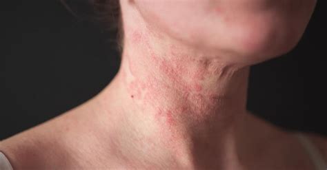 The Connection Between Eczema And Other Allergic Diseases Atlanta