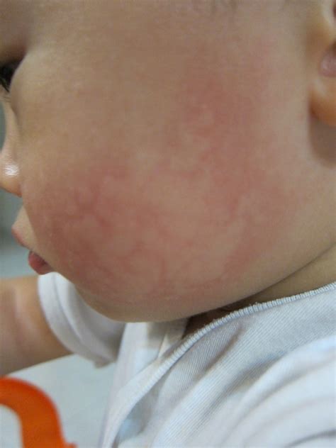 allergic skin reaction | Medical Pictures Info - Health Definitions Photos