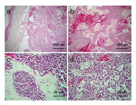 Plasmacytoid Myoepithelioma Of Minor Salivary Glands Report Of Case