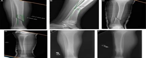 Nonoperative Management Of Closed Displaced Tibia Shaft Frac