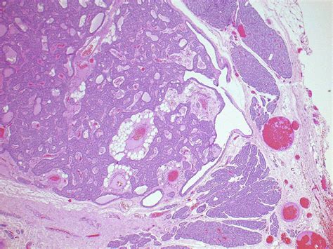Pathology Of The Parathyroid Glands Diagnostic Histopathology