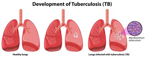 Tuberculosis Primaria