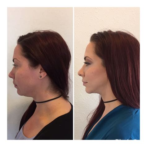 Kybella And Syringe Of Voluma In The Jawline Cheek Fillers Facial Fillers Botox Fillers