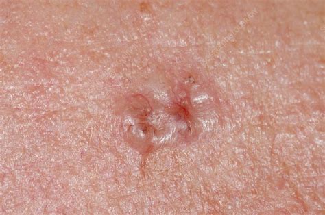 Recurrent Basal Cell Carcinoma Of The Forehead My Xxx Hot Girl