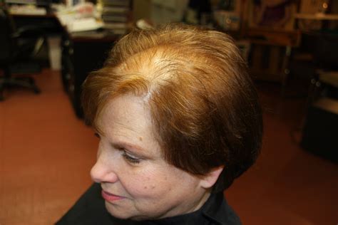 Flat wrap the hair to remove most of the moisture. Hair Replacement Alopecia Hair Loss Treatments Baldness