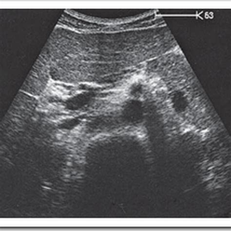 Ultrasound Images Of Superior Mesenteric Artery Radiology Imaging