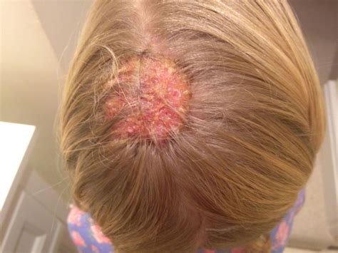 Kerion Celsi A Misdiagnosed Scalp Infection Archives Of Disease In