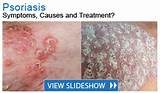Images of New Psoriasis Treatment Pill