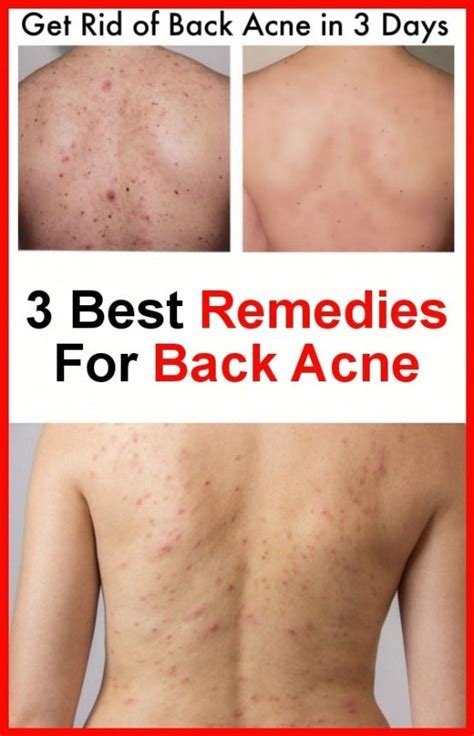 3 Best Repairs For Back Acne Best Acne Remedies Back Acne Remedies Acne
