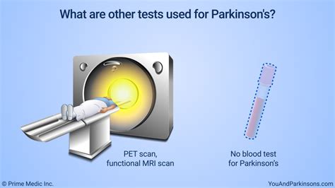 Slide Show Diagnosis Of Parkinsons Disease