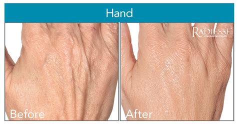 Radiesse Hand Rejuvenation Skinpossible Laser And Light Calgary Laser