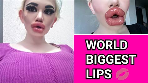 Women With Biggest Lips In The World Shows Off Huge New Pout After Th Injection YouTube