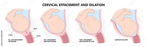 Cervical Effaces And Dilatation Vagina Delivery Labor Fetal Birth Giving Stage Cervix Uterine