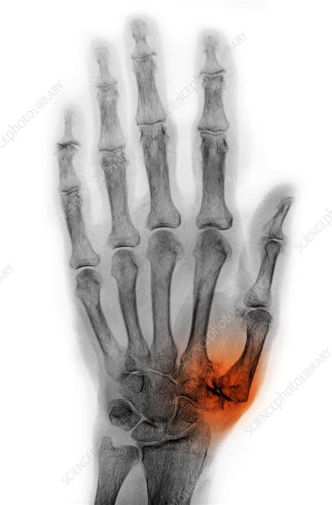 Arthritis In Hand X Ray Stock Image C0272642