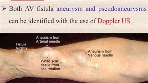Arm AV Fistula Dialysis