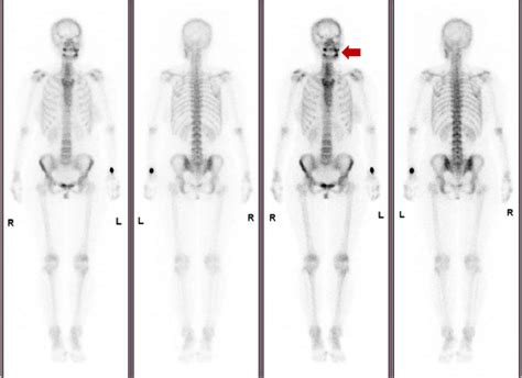 Whole Body Bone Spect Scan Exhibited Intense Focal Tracer Accumulation
