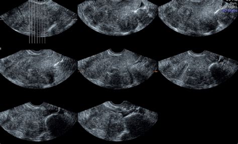 Tomographic Ultrasound Imaging Or Multi View Showing Different Cross