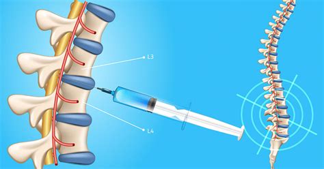 Lumbar Puncture Spine Procedure Series Mediphany